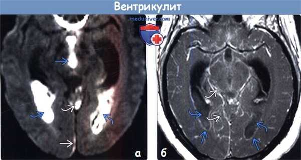 Вентрикулит на МРТ