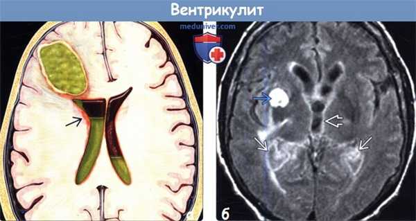 Вентрикулит на МРТ