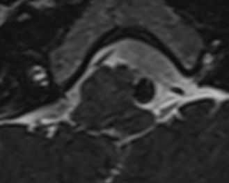 Долихоэктазия