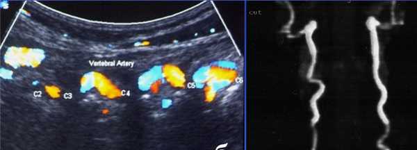 извитость ПА