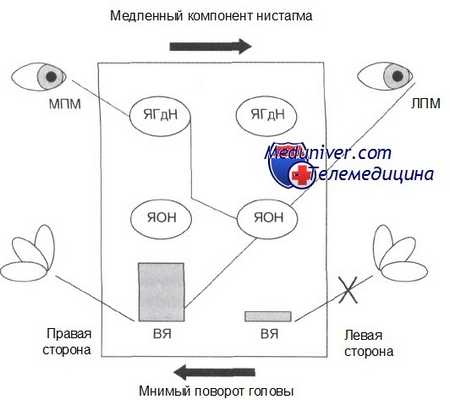 диагностика вестибулярного неврита