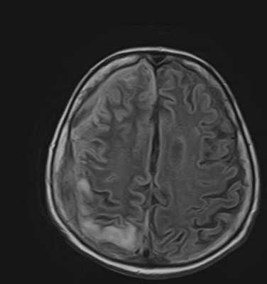 meningoencephalit_mrt