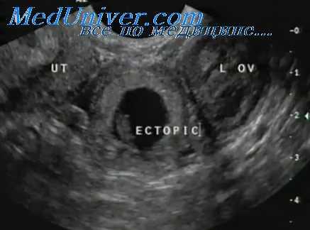 внематочная беременность