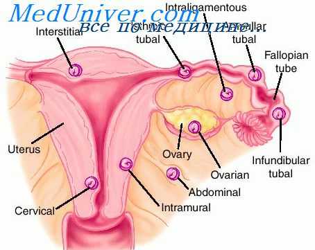 внематочная беременность