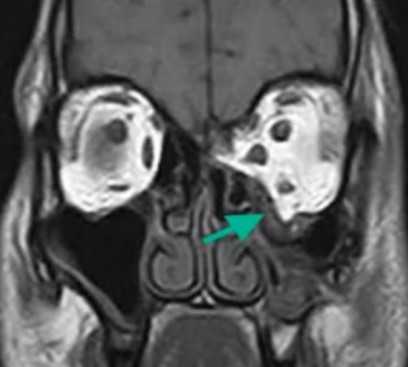 Взрывной перелом орбиты на МРТ