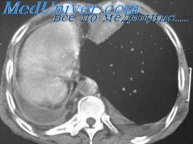 хилоторакс