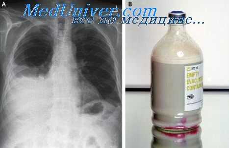 хилоторакс при травме грудного протока