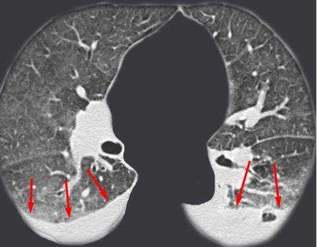 Хондросаркома