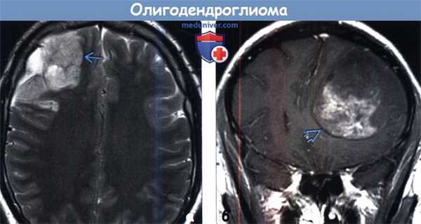 Олигодендроглиома на МРТ
