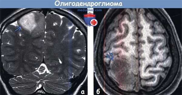 Олигодендроглиома на МРТ