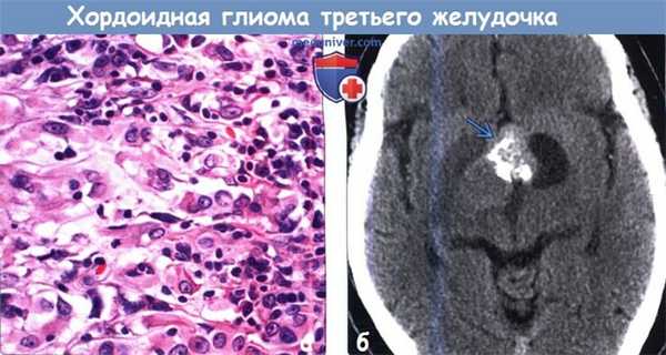 Хордоидная глиома третьего желудочка на КТ и ее морфология