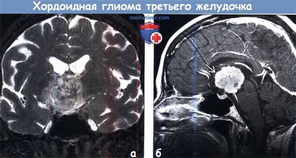 Хордоидная глиома третьего желудочка на МРТ