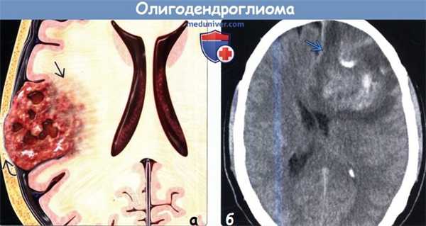 Олигодендроглиома на КТ