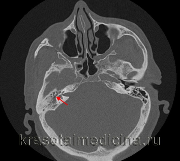 КТ височных костей. Содержимое (гной) в полости среднего уха вокруг слуховых косточек.