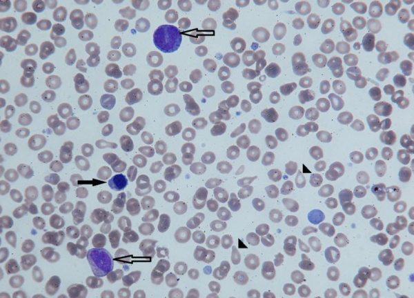 Незрелые формы эритроцитов (черная стрелка) и гранулоцитов (контурная стрелка) в периферической крови
