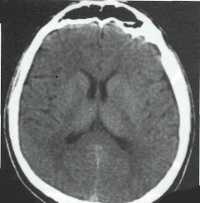 Субдуральная эмпиема