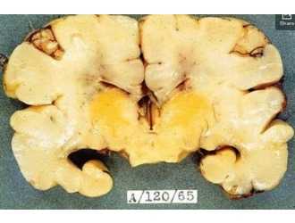 Ядерная желтуха получила такое название из-за того, что ядра головного мозга новорожденного окрашены в желтый цвет