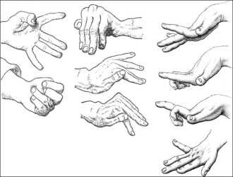 Хореоатетоз — заболевание, комбинация хореи (быстрые, порывистые движения) и атетоза (медленные судорожные движения)