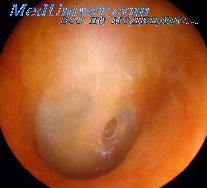 холестеатома