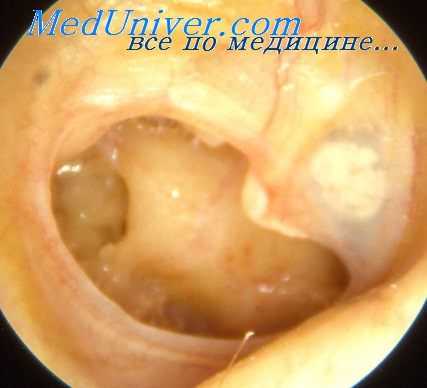 хронический мезотимпанит