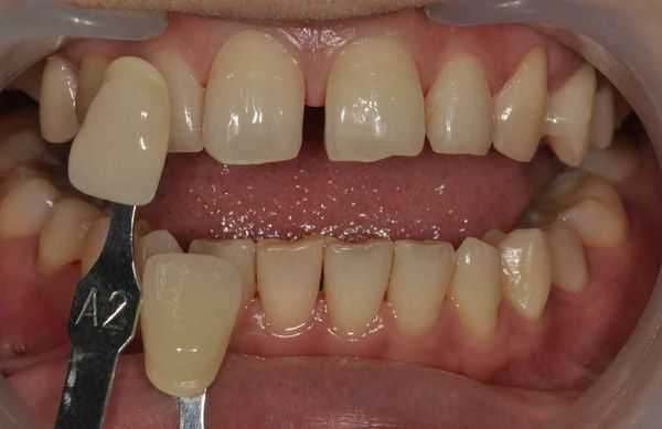 Установка виниров