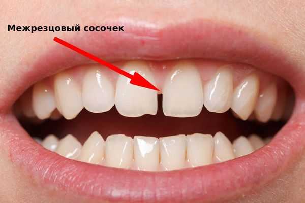 Межрезцовый сосочек