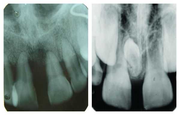 Диастема на рентгенограмме