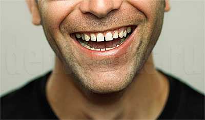 Диастема у мужчины