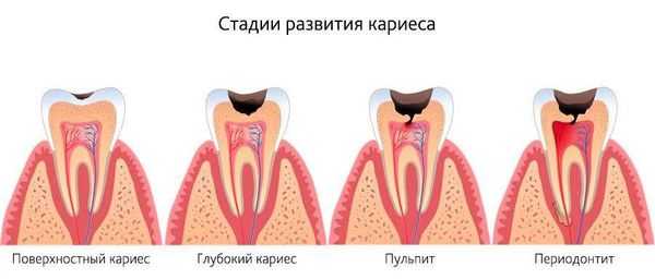Стадии развития кариеса