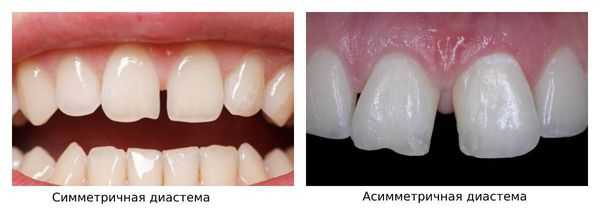 Симметричная и асимметричная диастемы