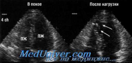 стресс-эхокардиография