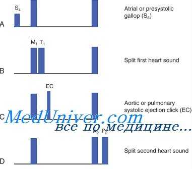 шумы сердца при инфаркте миокарда