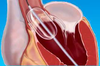 Баллонная вальвулопластика сердца