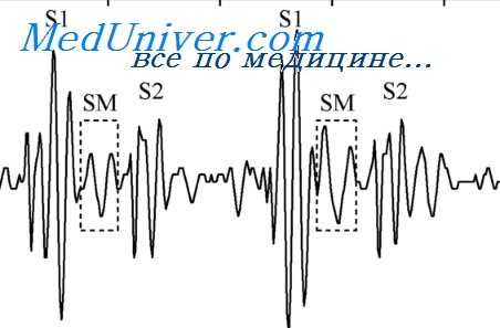 шумы сердца