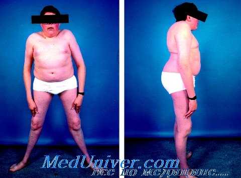 болезнь симмондса