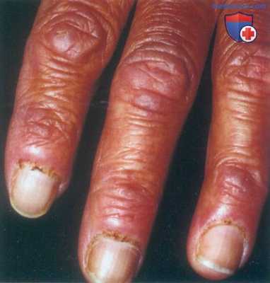 Дерматомиозит