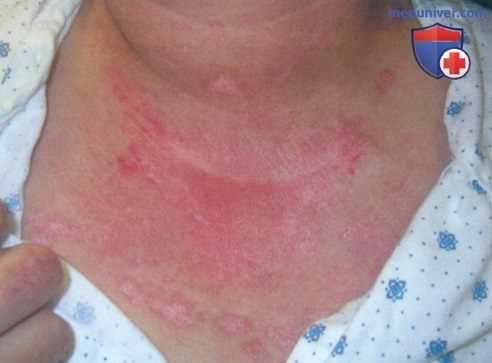 Дерматомиозит