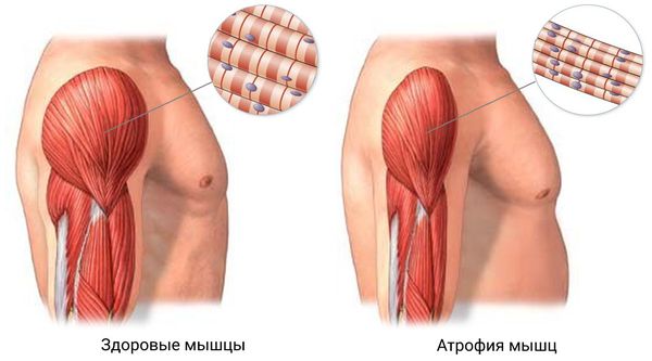 Атрофия мышц
