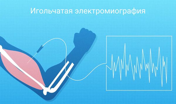 Игольчатую электромиографию