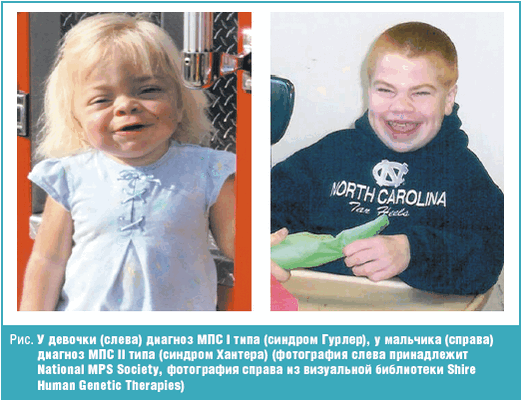 У девочки диагноз МПС I типа, у мальчика диагноз МПС II типа