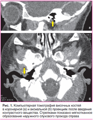 Рис. 1. Компьютерная томография височных костей в коронарной (а) и аксиальной (б) проекциях после введения контрастного вещества. Стрелками показано мягкотканное образование наружного слухового прохода справа