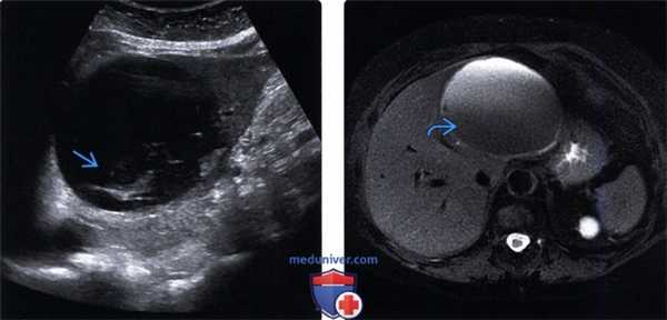 УЗИ печени при кисте