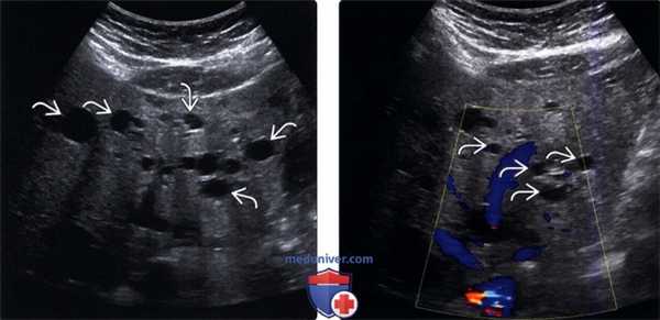 УЗИ печени при кисте
