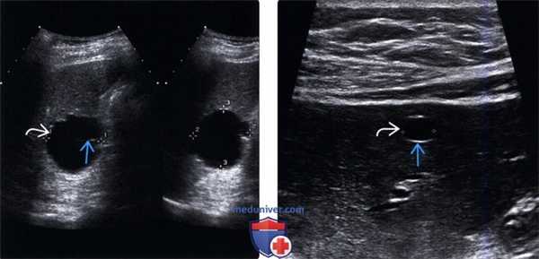 УЗИ печени при кисте