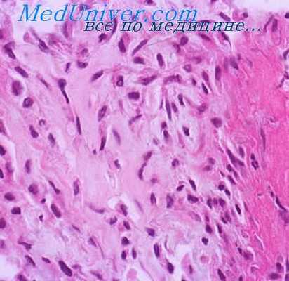 зернистоклеточная опухоль