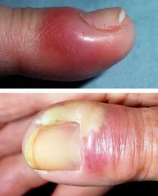 острая форма паронихии