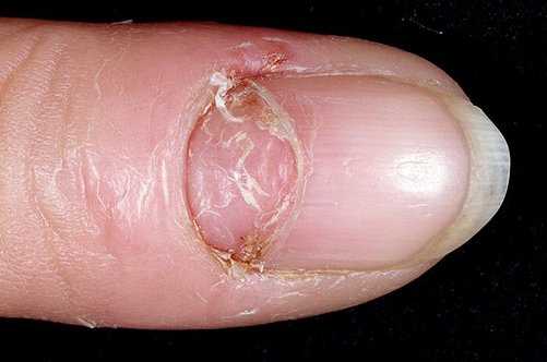 кандидозный паронихий