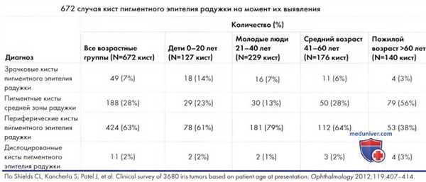 Киста пигментного эпителия радужки