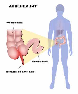 Аппендицит.jpg