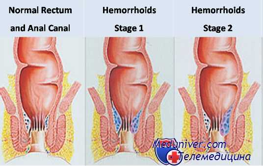 анальные сосочки